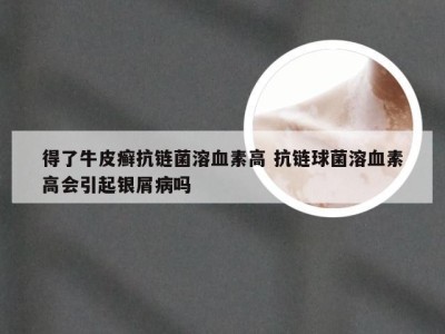 得了牛皮癣抗链菌溶血素高 抗链球菌溶血素高会引起银屑病吗