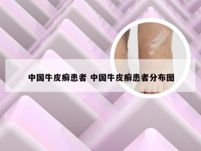 中国牛皮癣患者 中国牛皮癣患者分布图