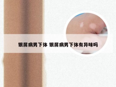 银屑病男下体 银屑病男下体有异味吗