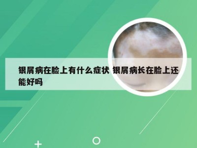 银屑病在脸上有什么症状 银屑病长在脸上还能好吗