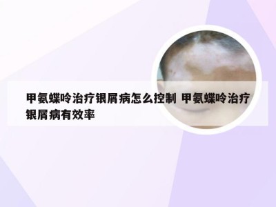 甲氨蝶呤治疗银屑病怎么控制 甲氨蝶呤治疗银屑病有效率