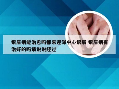 银屑病能治愈吗都来迎泽中心银屑 银屑病有治好的吗请说说经过
