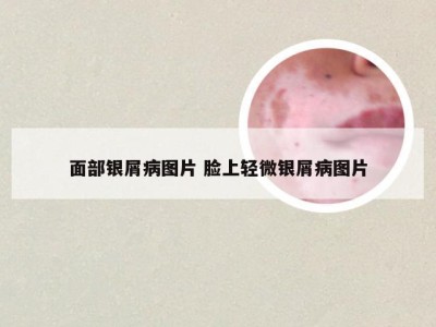 面部银屑病图片 脸上轻微银屑病图片