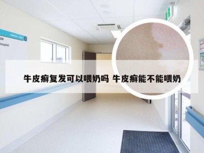 牛皮癣复发可以喂奶吗 牛皮癣能不能喂奶