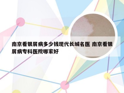 南京看银屑病多少钱现代长城名医 南京看银屑病专科医院哪家好