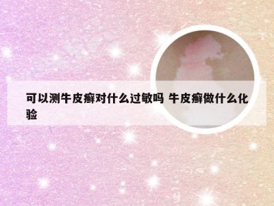 可以测牛皮癣对什么过敏吗 牛皮癣做什么化验