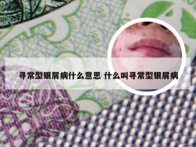 寻常型银屑病什么意思 什么叫寻常型银屑病