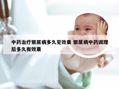 中药治疗银屑病多久见效果 银屑病中药调理后多久有效果