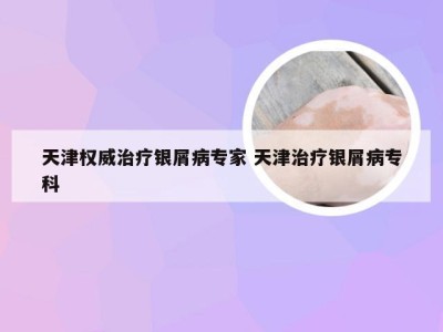 天津权威治疗银屑病专家 天津治疗银屑病专科