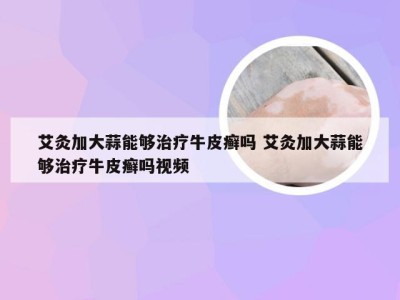 艾灸加大蒜能够治疗牛皮癣吗 艾灸加大蒜能够治疗牛皮癣吗视频