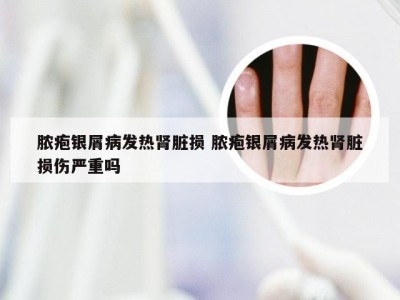 脓疱银屑病发热肾脏损 脓疱银屑病发热肾脏损伤严重吗