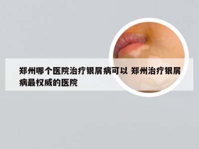 郑州哪个医院治疗银屑病可以 郑州治疗银屑病最权威的医院