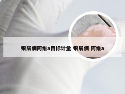 银屑病阿维a目标计量 银屑病 阿维a