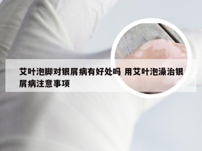 艾叶泡脚对银屑病有好处吗 用艾叶泡澡治银屑病注意事项