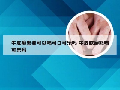 牛皮癣患者可以喝可口可乐吗 牛皮肤癣能喝可乐吗
