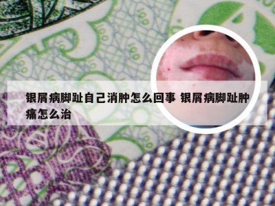 银屑病脚趾自己消肿怎么回事 银屑病脚趾肿痛怎么治
