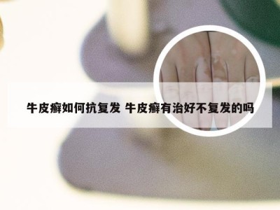 牛皮癣如何抗复发 牛皮癣有治好不复发的吗