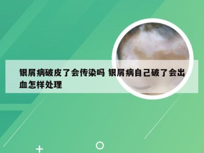 银屑病破皮了会传染吗 银屑病自己破了会出血怎样处理
