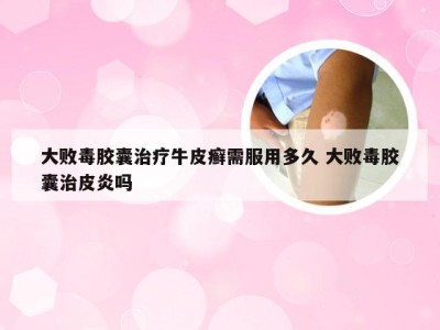 大败毒胶囊治疗牛皮癣需服用多久 大败毒胶囊治皮炎吗