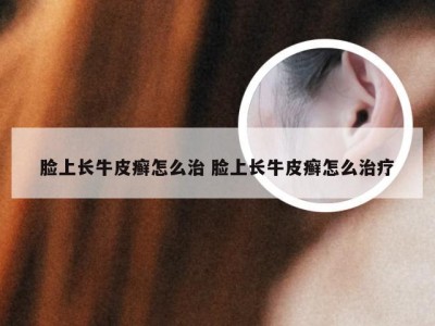 脸上长牛皮癣怎么治 脸上长牛皮癣怎么治疗