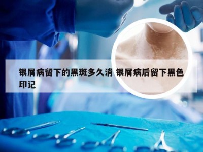 银屑病留下的黑斑多久消 银屑病后留下黑色印记