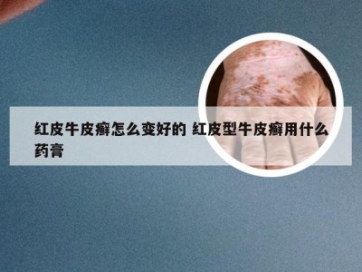 红皮牛皮癣怎么变好的 红皮型牛皮癣用什么药膏