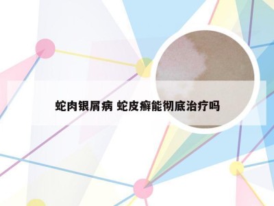 蛇肉银屑病 蛇皮癣能彻底治疗吗