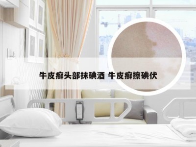牛皮癣头部抹碘酒 牛皮癣擦碘伏