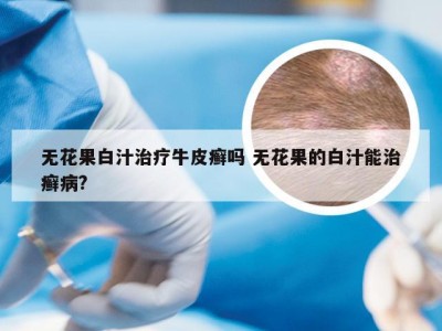 无花果白汁治疗牛皮癣吗 无花果的白汁能治癣病?