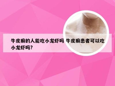 牛皮癣的人能吃小龙虾吗 牛皮癣患者可以吃小龙虾吗?