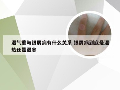 湿气重与银屑病有什么关系 银屑病到底是湿热还是湿寒