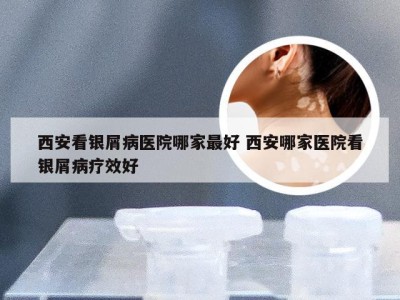 西安看银屑病医院哪家最好 西安哪家医院看银屑病疗效好