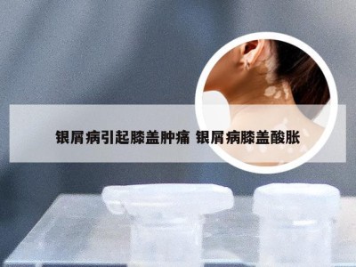 银屑病引起膝盖肿痛 银屑病膝盖酸胀