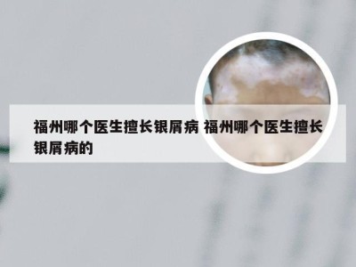 福州哪个医生擅长银屑病 福州哪个医生擅长银屑病的