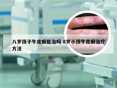 八岁孩子牛皮癣能治吗 8岁小孩牛皮癣治疗方法