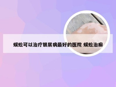 蜈蚣可以治疗银屑病最好的医院 蜈蚣治癣