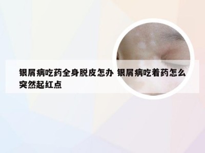 银屑病吃药全身脱皮怎办 银屑病吃着药怎么突然起红点