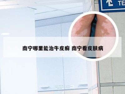 南宁哪里能治牛皮癣 南宁看皮肤病