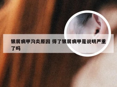 银屑病甲沟炎原因 得了银屑病甲是说明严重了吗