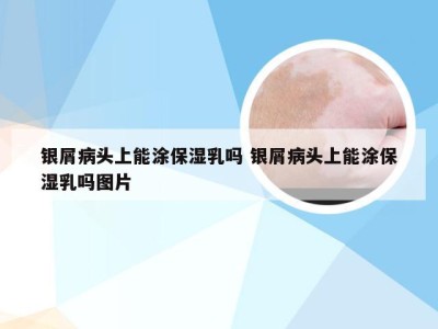 银屑病头上能涂保湿乳吗 银屑病头上能涂保湿乳吗图片