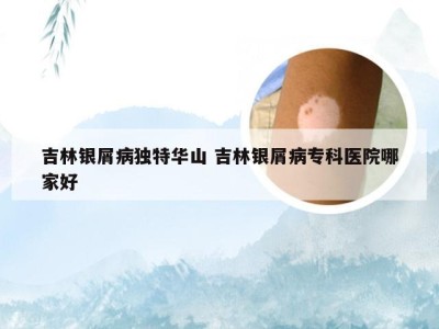 吉林银屑病独特华山 吉林银屑病专科医院哪家好