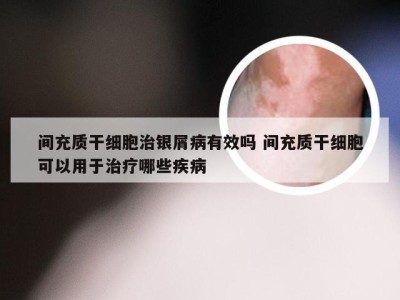 间充质干细胞治银屑病有效吗 间充质干细胞可以用于治疗哪些疾病