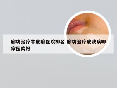 廊坊治疗牛皮癣医院排名 廊坊治疗皮肤病哪家医院好