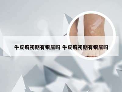 牛皮癣初期有银屑吗 牛皮癣初期有银屑吗