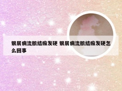 银屑病流脓结痂发硬 银屑病流脓结痂发硬怎么回事