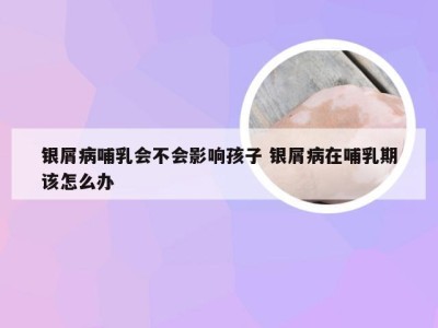 银屑病哺乳会不会影响孩子 银屑病在哺乳期该怎么办