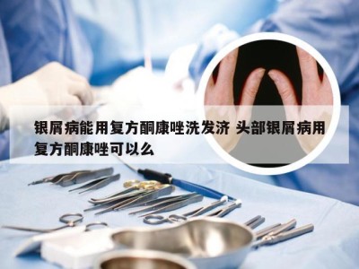 银屑病能用复方酮康唑洗发济 头部银屑病用复方酮康唑可以么