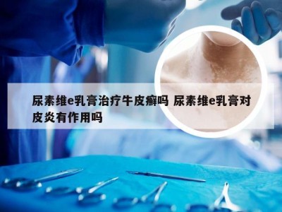 尿素维e乳膏治疗牛皮癣吗 尿素维e乳膏对皮炎有作用吗