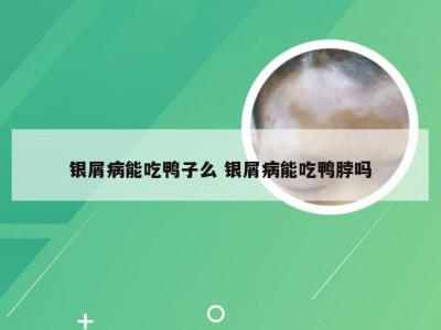 银屑病能吃鸭子么 银屑病能吃鸭脖吗