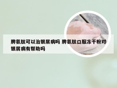脾氨肽可以治银屑病吗 脾氨肽口服冻干粉对银屑病有帮助吗
